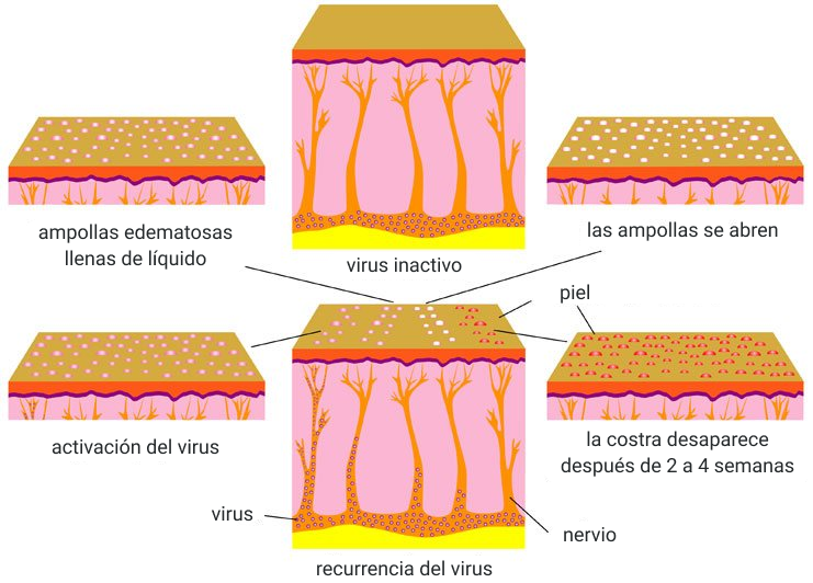 Herpes zoster